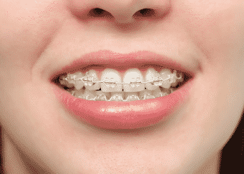 hình ảnh Dịch vụ thẩm mỹ niềng răng hô hàm trên giá bao nhiêu? - số 3