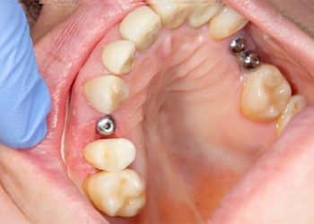 hình ảnh 7 câu hỏi thường gặp trước khi trồng răng implant - số 22
